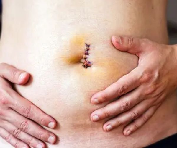 النقاهة بعد عملية الفتق الإربي للأطفال