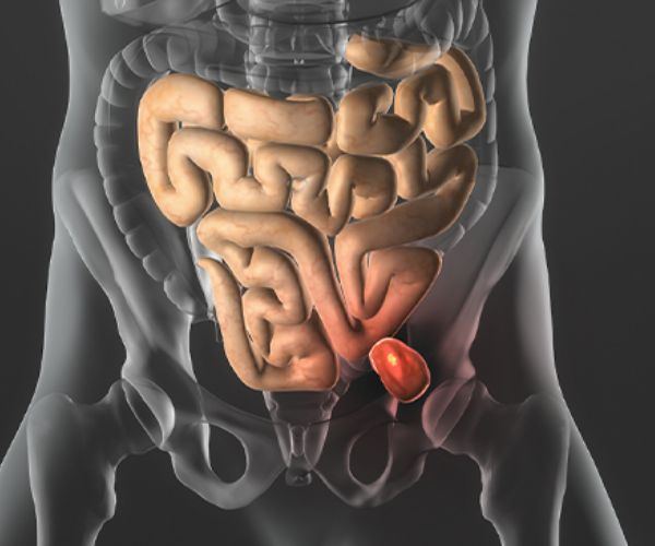 الفتق يؤثر على الإنجاب