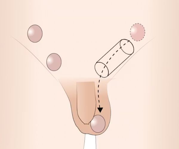 الفرق بين الخصية المعلقة والنطاطة