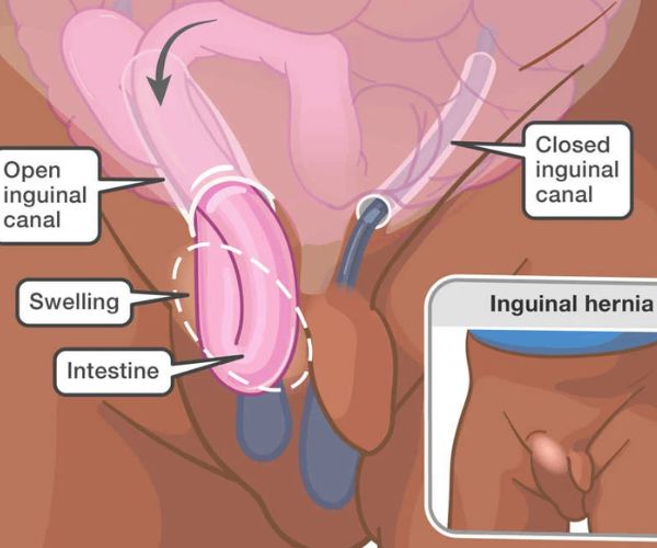 عملية الفتق الاربي للاطفال