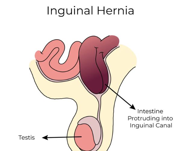 عملية الفتق الاربي للاطفال