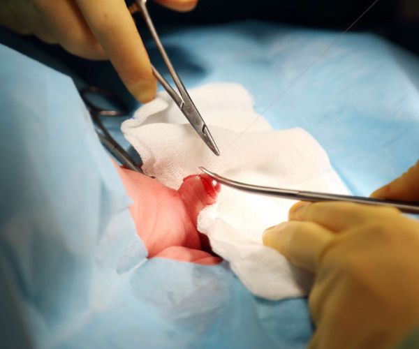 موانع الختان عند الرضع