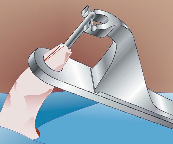 موانع الختان عند الرضع