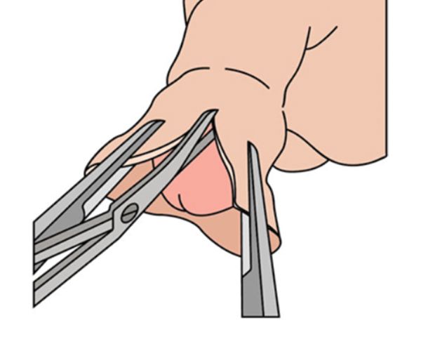 موانع الختان عند الرضع