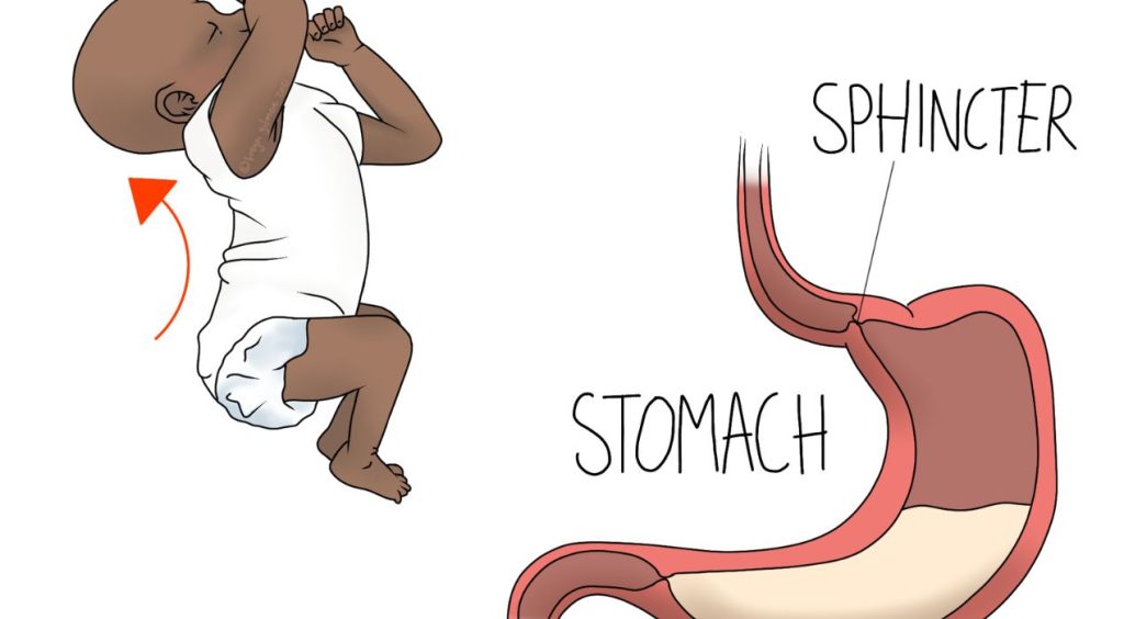 ارتجاع المريء عند الرضع