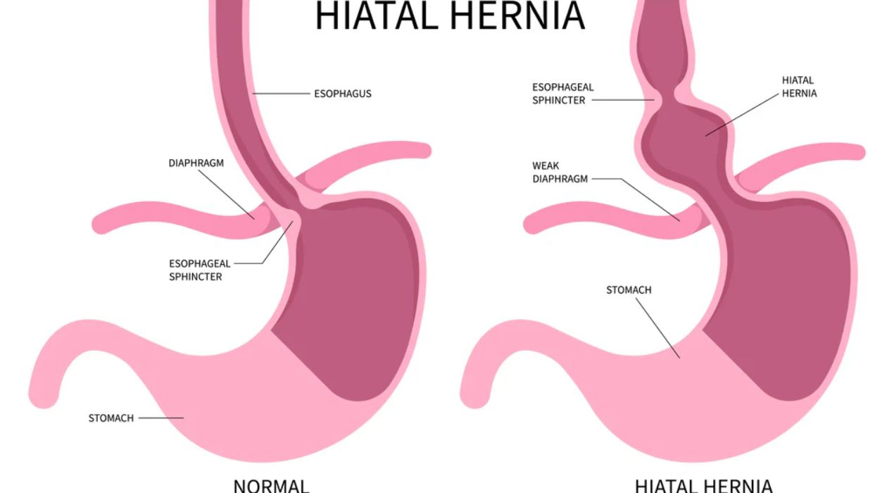 هل يوجد العلاقة بين ارتجاع المرئ وفتق الحجاب الحاجز؟..اليك الرد