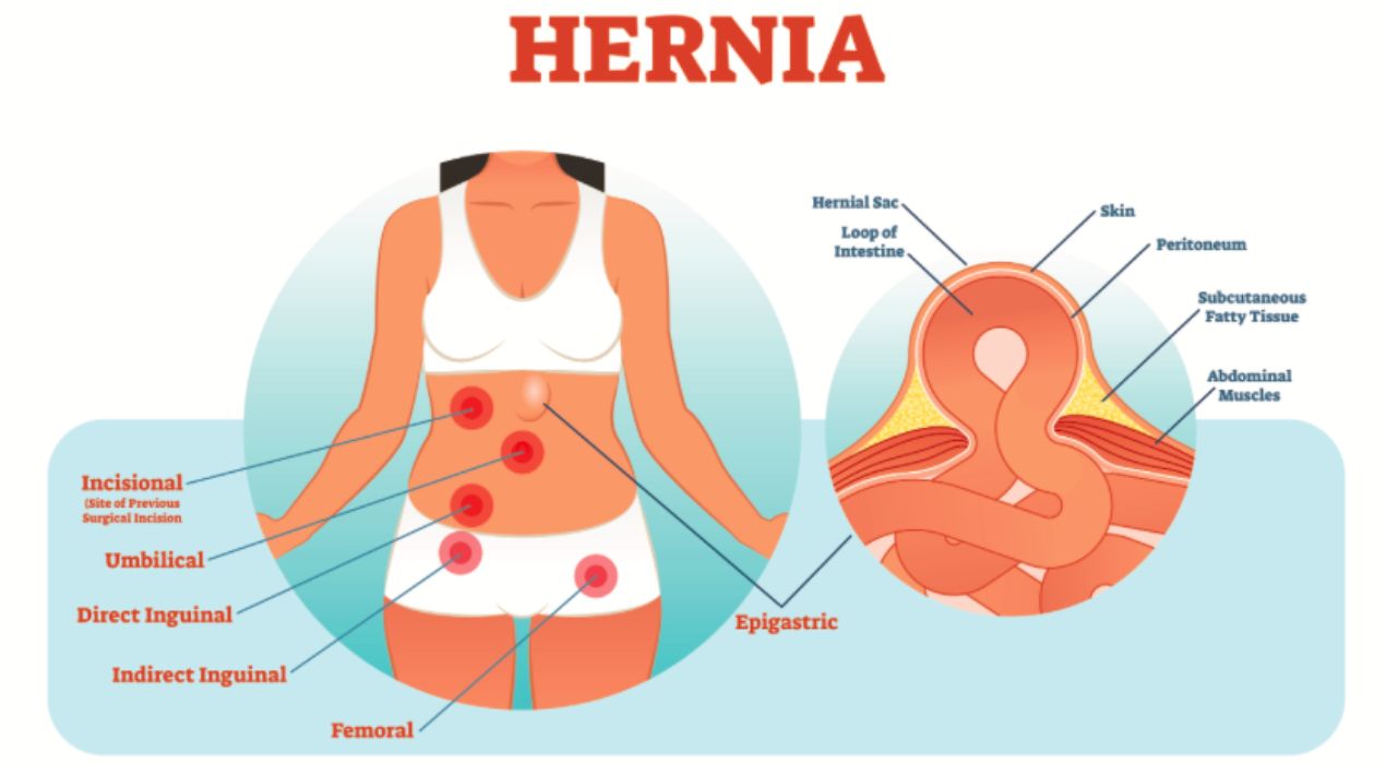 ما هي أعراض الفتق عند الأطفال البنات؟ علامات يجب الانتباه لها