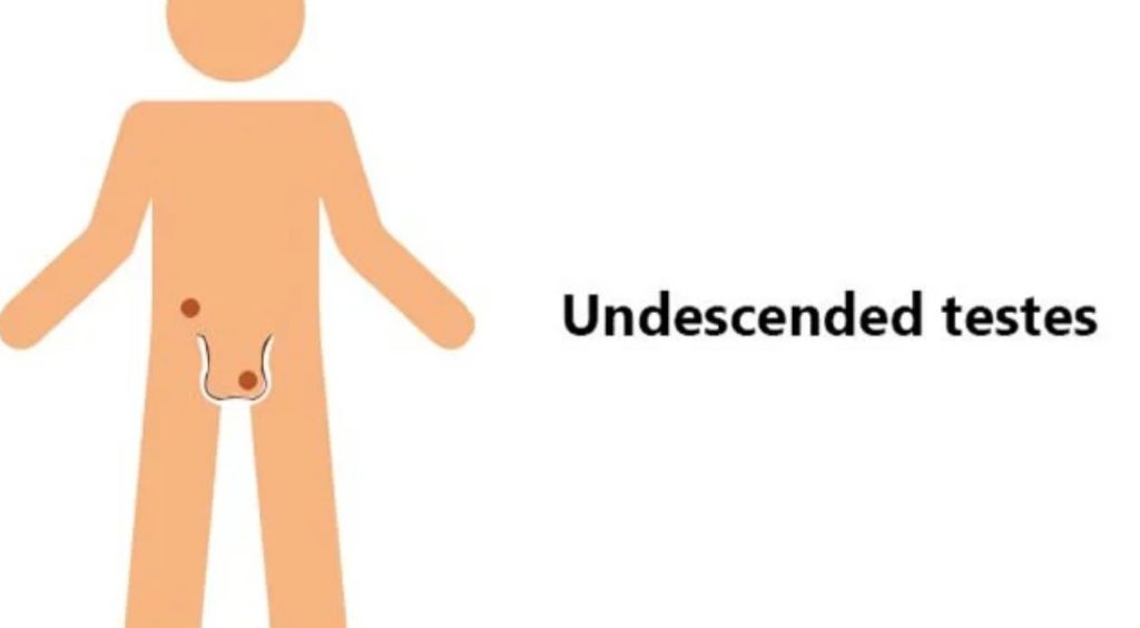 الفرق بين الخصية المعلقة والنطاطة